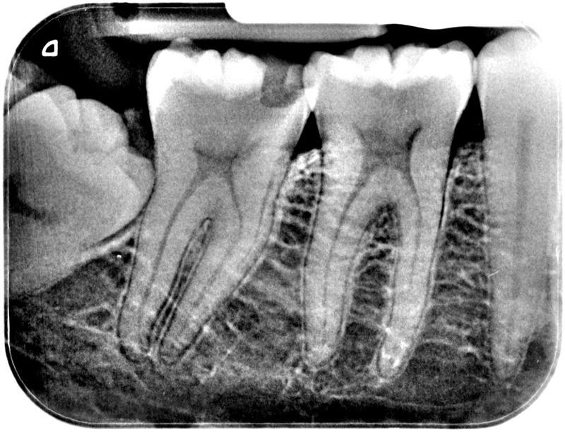 Radiografía periapical digital