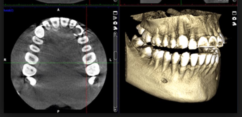 Tomografía CBCT